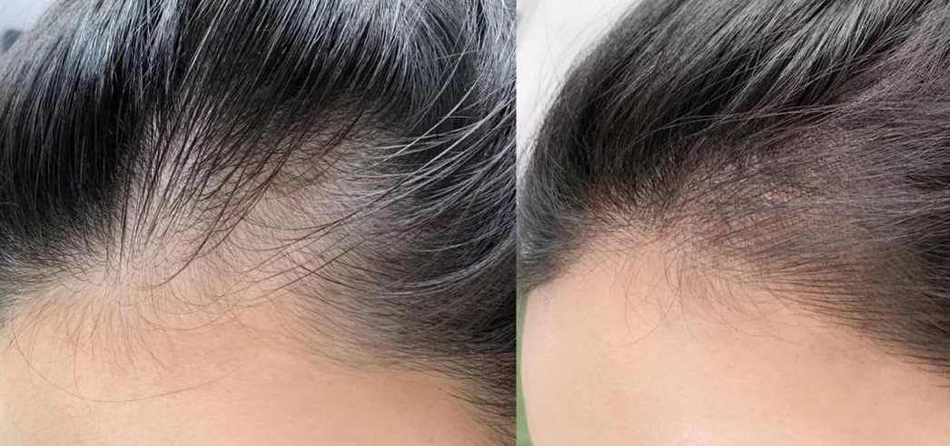 Hairline Embroidery
